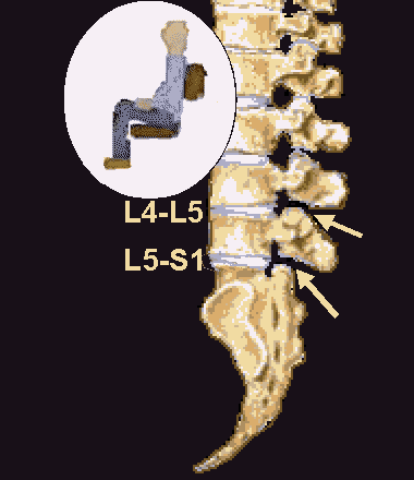 L5 S1 Spine