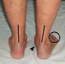 Posterior Tibial Syndrome Conformation