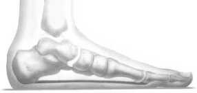 Picture of flat foot